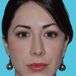 Chin Surgery Before & After Patient #870
