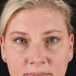 Brow Lift Before & After Patient #884