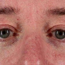 Blepharoplasty (Eyelid Surgery) Before & After Patient #895