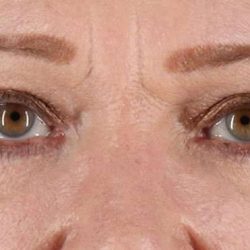 Blepharoplasty (Eyelid Surgery) Before & After Patient #902