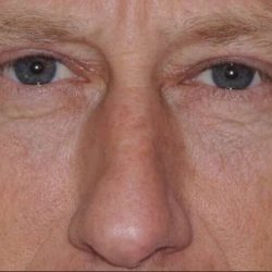 Blepharoplasty (Eyelid Surgery) Before & After Patient #909