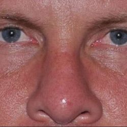 Blepharoplasty (Eyelid Surgery) Before & After Patient #916