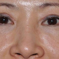 Blepharoplasty (Eyelid Surgery) Before & After Patient #923