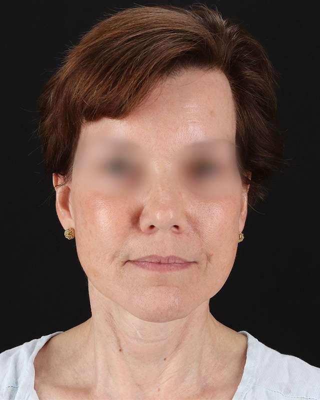 All Me Facelift Before & After Patient #229