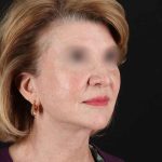 All Me Facelift Before & After Patient #240