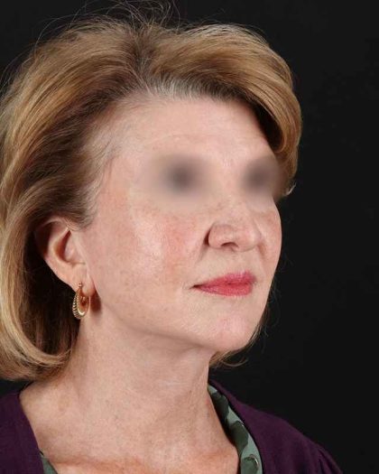 All Me Facelift Before & After Patient #240
