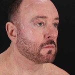 All Me Facelift Before & After Patient #343