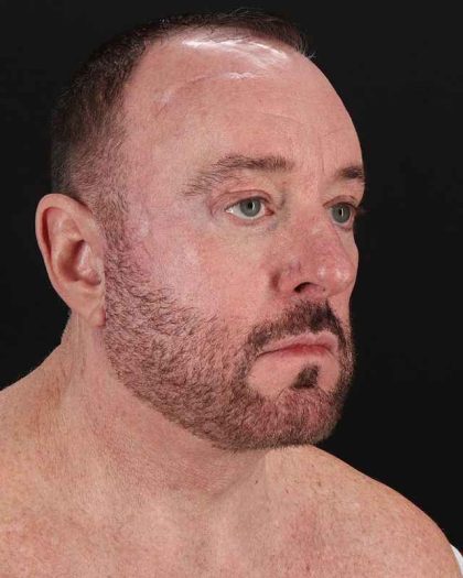 All Me Facelift Before & After Patient #343
