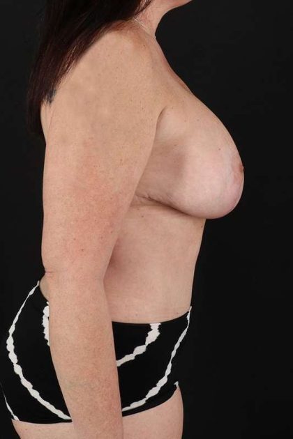 All Me Augmentation Before & After Patient #1204