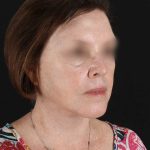 All Me Facelift Before & After Patient #354