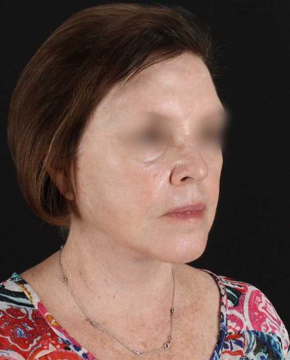 All Me Facelift Before & After Patient #354