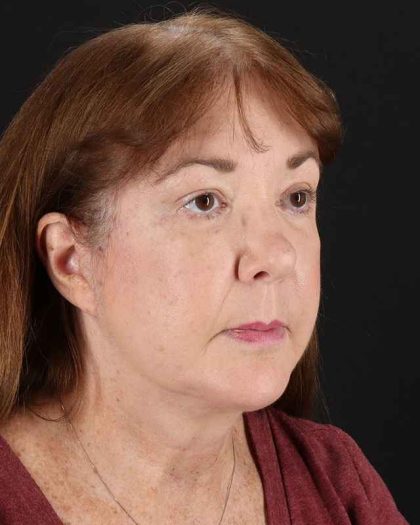 All Me Facelift Before & After Patient #366