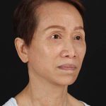 All Me Facelift Before & After Patient #395