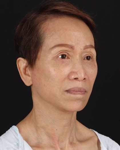 All Me Facelift Before & After Patient #395