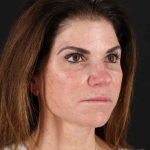 All Me Facelift Before & After Patient #406