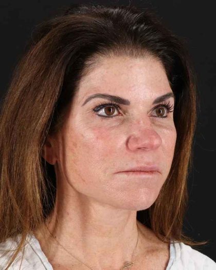 All Me Facelift Before & After Patient #406