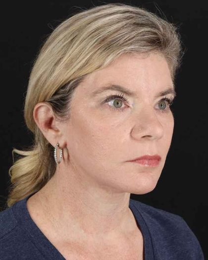 All Me Facelift Before & After Patient #428