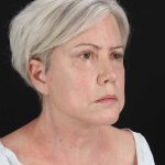 All Me Facelift Before & After Patient #439