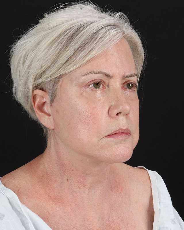 All Me Facelift Before & After Patient #439
