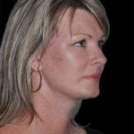 All Me Facelift Before & After Patient #252