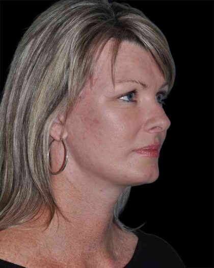 All Me Facelift Before & After Patient #252
