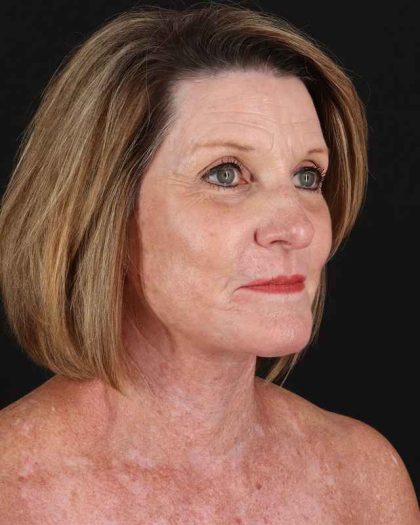 All Me Facelift Before & After Patient #461
