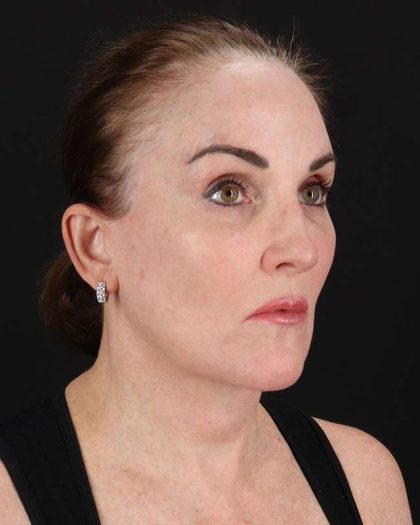 All Me Facelift Before & After Patient #472