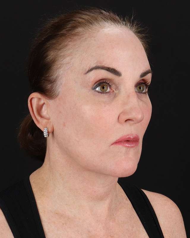 All Me Facelift Before & After Patient #472