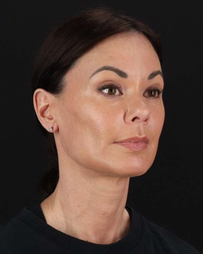 All Me Facelift Before & After Patient #483