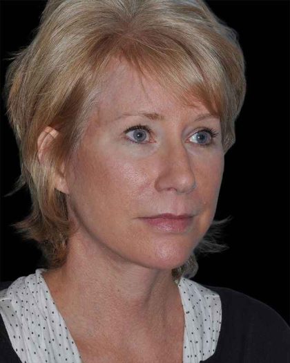 All Me Facelift Before & After Patient #263