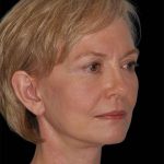 All Me Facelift Before & After Patient #274