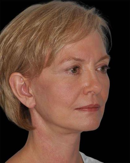 All Me Facelift Before & After Patient #274