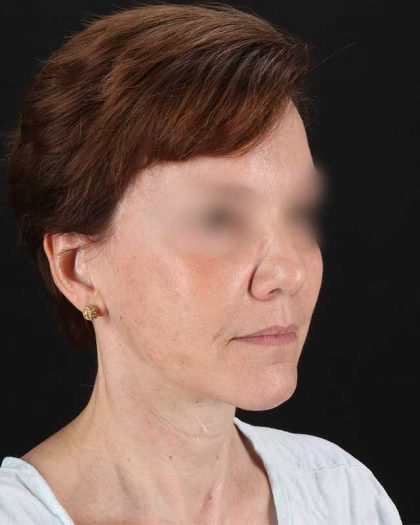 All Me Facelift Before & After Patient #229