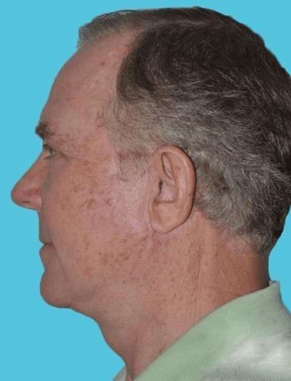 All Me Facelift Before & After Patient #735