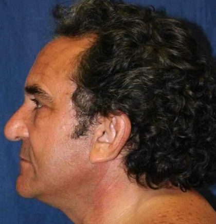 All Me Facelift Before & After Patient #742