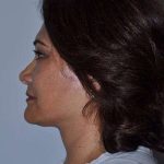 All Me Facelift Before & After Patient #749