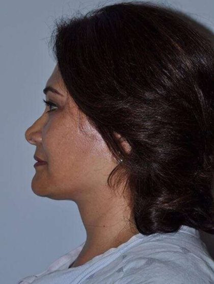 All Me Facelift Before & After Patient #749