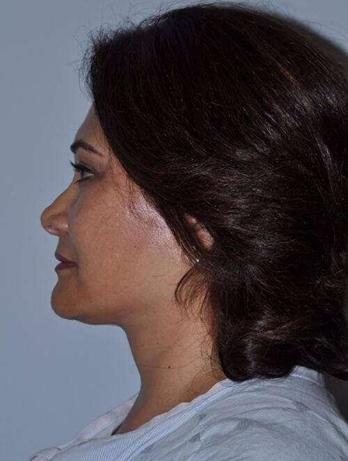 All Me Facelift Before & After Patient #749