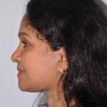 All Me Facelift Before & After Patient #756