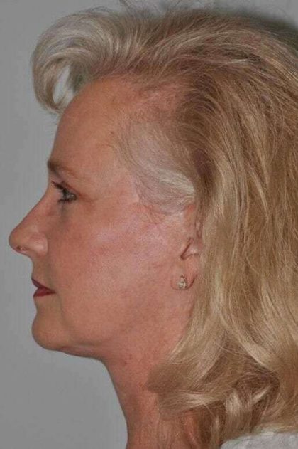 All Me Facelift Before & After Patient #763