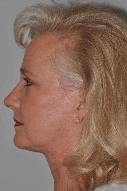 All Me Facelift Before & After Patient #763