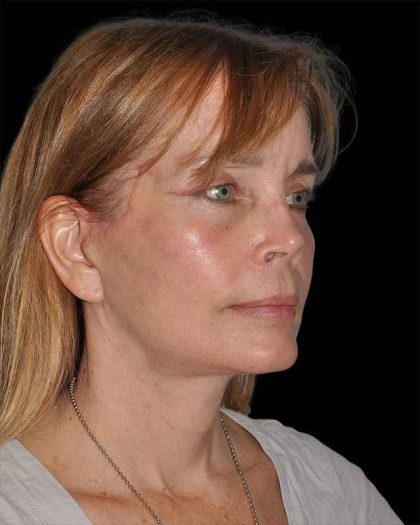 All Me Facelift Before & After Patient #297