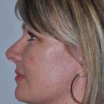 All Me Facelift Before & After Patient #781