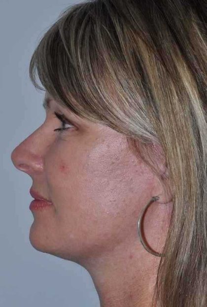 All Me Facelift Before & After Patient #781