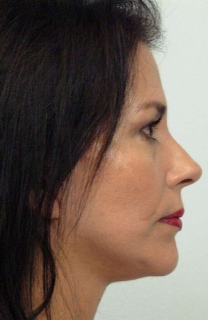 All Me Facelift Before & After Patient #786