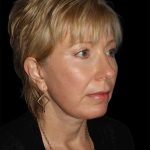 All Me Facelift Before & After Patient #308