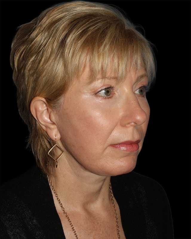 All Me Facelift Before & After Patient #308