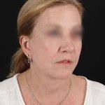 All Me Facelift Before & After Patient #320
