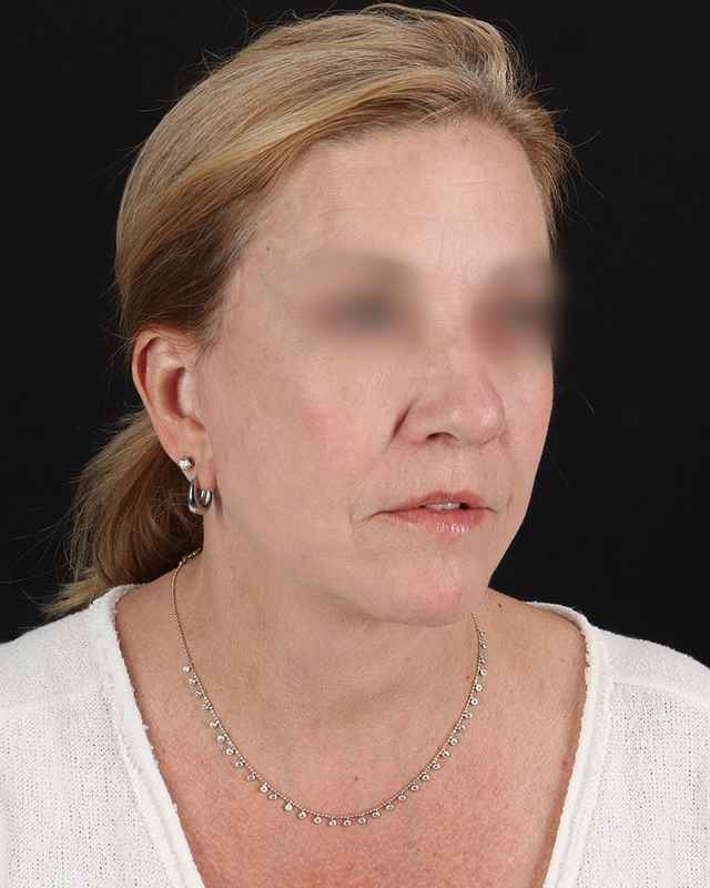 All Me Facelift Before & After Patient #320