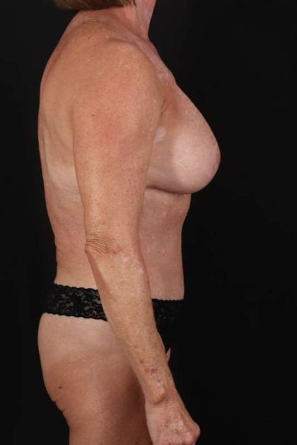 All Me Augmentation Before & After Patient #1190